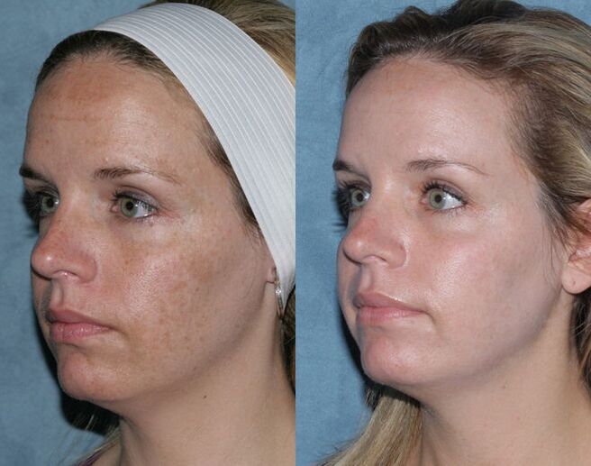 before and after fractional laser resurfacing