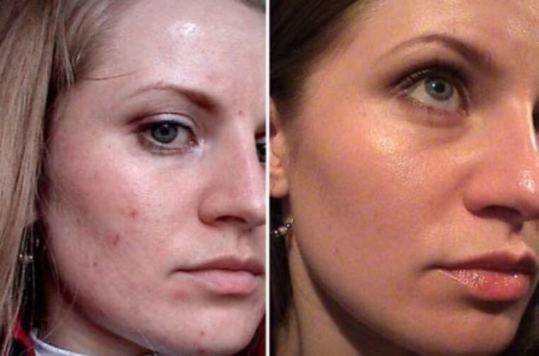 Skin quality correction