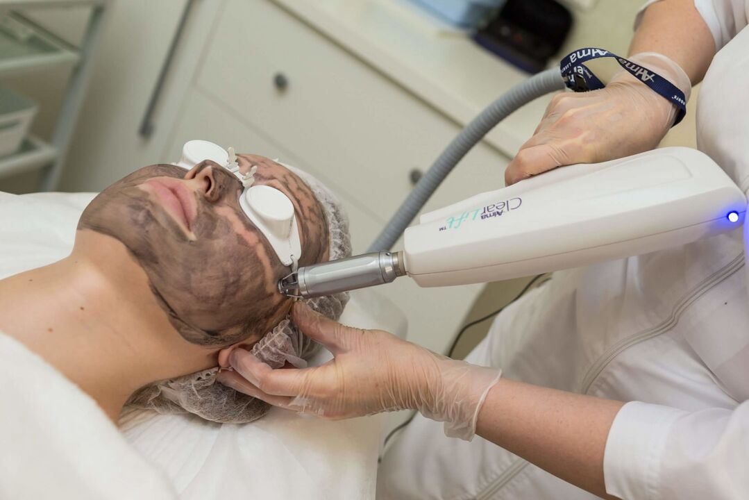 Laser facial peeling session