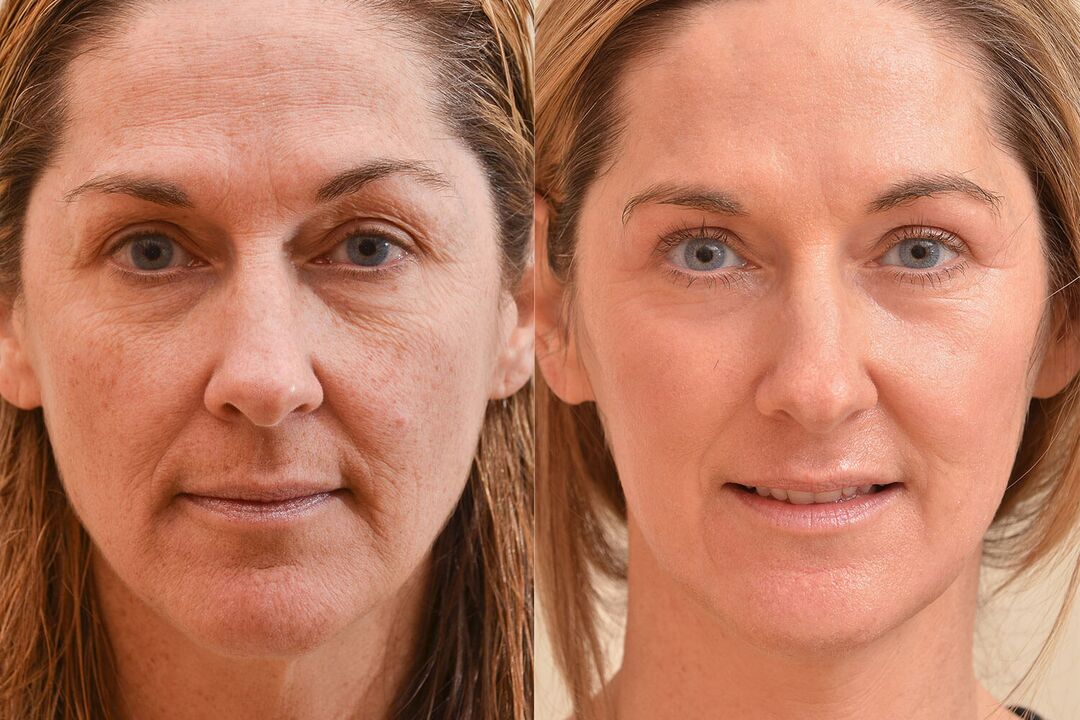 The result of laser skin resurfacing