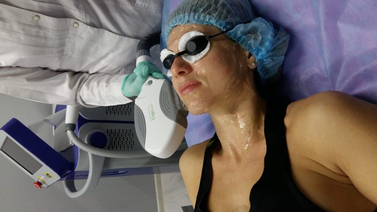 The use of a laser in conjunction with a gel for gentle skin rejuvenation. 