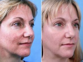 Photos before and after fractional skin rejuvenation.