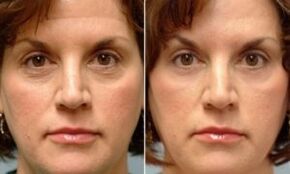 before and after the fractional rejuvenation procedure