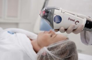 fractional laser resurfacing machine