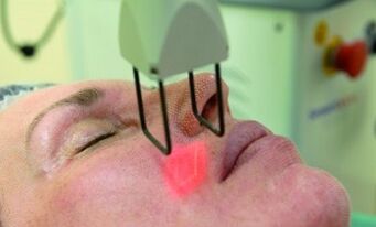 Carrying out fractional laser rejuvenation procedures.